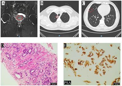 Systemic metastases in large cell neuroendocrine prostate cancer: a rare case report and literature review